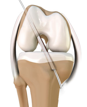 acl-reconstruction