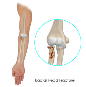 Radial Head Fracture
